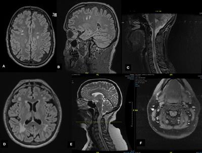 Case Series: Myelin Oligodendrocyte Glycoprotein-Immunoglobulin G-Related Disease Spectrum